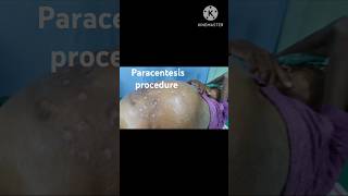 Paracentesis procedure  Liver Cirrhosis [upl. by Eeb]