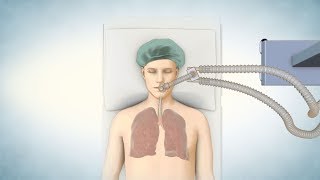 Lung Transplant Process [upl. by Nawd]