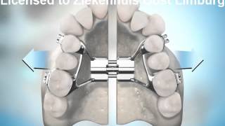 Surgically Assisted Palatal Expansion SRPE [upl. by Purpura632]