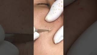 Best Pimple Popping 13 reels beautiful blackheads sacdepspa cute health [upl. by Tavish864]