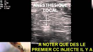 BLOC DU NERF OBTURATEUR POUR RESECTION DE TUMEUR DE VESSIE [upl. by Ecnarwal]