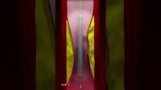 Coronary Artery Stent Placement Animation [upl. by Ayocal]