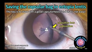 CataractCoach™ 2328 saving the capsular bag in ectopia lentis [upl. by Inotna]