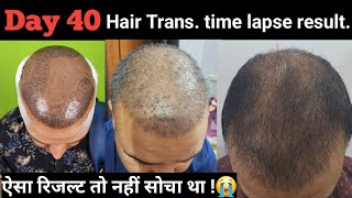 Day 40 My hair transplant result  Time lapse ऐसा रिजल्ट तो नहीं सोचा था [upl. by Dorey68]