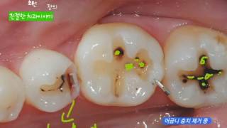 충치치료 어금니 충치치료과정 및 치료법 레진 인레이 때우기 [upl. by Brent]