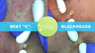 quotKsquot Best Blackhead Extraction Compilation Part 1 [upl. by Luzader]