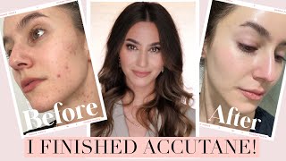 I FINISHED ACCUTANE 🎉 Results  Side Effects Low Dose Isotretinoin Journey  Karima McKimmie [upl. by Dualc198]