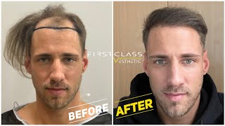 Hair Transplant Growth Timeline  Day 1 To Day 365 Before amp After  FirstClassEsthetic in Turkey [upl. by Krasner]