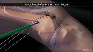 Reparation ligament fémoropatellaire MPFL  Chirurgie Instabilité de rotule  Dr Tournemine [upl. by Etirugram]