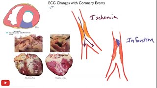 Myocardial ischemia amp infarction  STEMI NSTEMI Q wave infarction Wellens syndrome [upl. by Grayson]