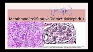 Membranoproliferative Glomerulonephritis MPGN [upl. by Roxanna]