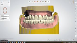 Bite Rim Scans For Complete Denture Digital Design [upl. by Anilet926]