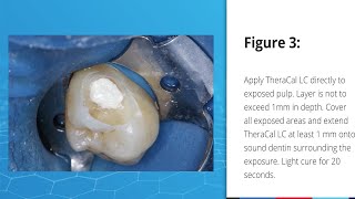 Direct Pulp Capping Case using TheraCal LC [upl. by Ahsenauq]