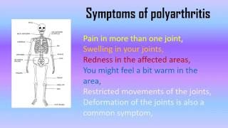 What is Polyarthritis Symptoms and Treatment  Hooolcom [upl. by Inuat]