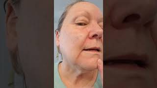 Healing on Day 20 after a 21 day 5 Fluorouracil treatment for Basal Cell Carcinoma 2132023 [upl. by Riddle310]