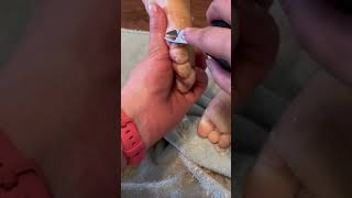 Removing callus from kid toes  Keratoderma hyperkeratosis EPPK skin shaving callous  May 30 2023 [upl. by Ahseal]