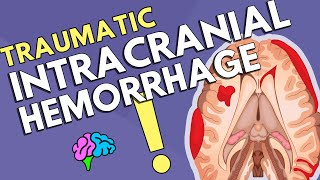 Intracranial Hemorrhage [upl. by Htebizile582]