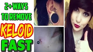 How To Get Rid Of Keloid  2 Ways To Remove Keloids Naturally at home [upl. by Neenaej536]