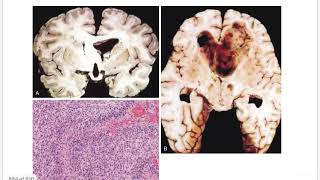 TUMORS Of CNS  Gliomas Astrocytoma  Oligodendroglioma  Midline Glioma  Ependymoma [upl. by Jacquenetta]