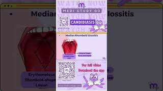 Median Rhomboid Glossitis  Oral Medicine  Medi Study Go [upl. by Alicea]