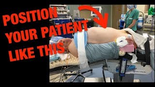 Robotic Right Colectomy Patient Positioning 101 [upl. by Ddet]