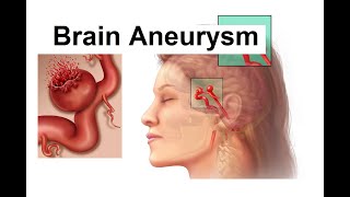 Brain Aneurysm Pathology  Etiology  Pathogenesis  Clinical manifestations  Diagnosis amp Treatment [upl. by Rosenblast]