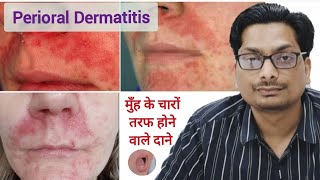 मुँह के चारों तरफ होने वाले दाने  Perioral Dermatitis  Red rash around mouth  Skin rash mouth [upl. by Audwin167]