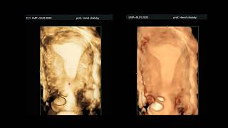 ultrasonography of the myometrium [upl. by Jessee]