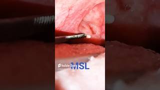 Tonsil Stone Removal [upl. by Sells204]