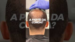 TRANSPLANTE CAPILAR FUE  SOLUÇÃO PARA CALVICIE PERDA DE CABELO [upl. by Vastha]