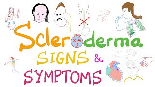 Scleroderma Pathogenesis and Clinical Manifestations Detailed Explanation [upl. by Lexa]