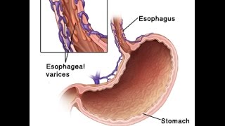 Esophageal Varices [upl. by Dougald]