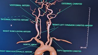 BRAIN AND NECK ANGIOGRAPHY On Ct scanALL ABOUT ANGIOGRAPHYPART1CONCEPT ON ANGIOGRAPHY [upl. by Aitnas]