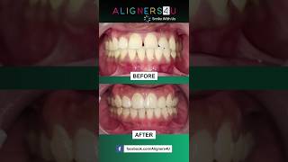 quotBefore amp After Transformationquot  Best Clear Aligners In Hyderabad  Invisible  Braces  Smile [upl. by Harv43]