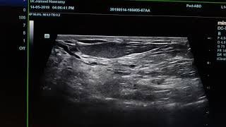 Fibrocystic Breast Disease Sonography [upl. by Finlay]