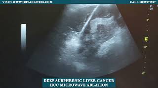 Deep Subphrenic Liver Cancer HCC Microwave Ablation [upl. by Ellesij]