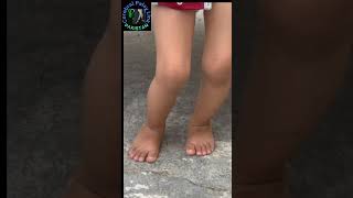 Cerebral Palsy Diplegic with Crouch Gait can only stands with Crouch Posture [upl. by Cromwell]