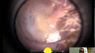 normal ear exam of the tympanic membrane [upl. by Euqinom]