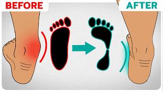 How to Correct Overpronation Fallen Arches [upl. by Mcginnis]