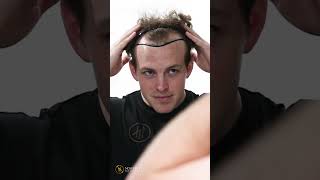 Hair Transplant Journey hairtrasnplantturkey sapphirehairtransplant nowhairtime hairtransplant [upl. by Allit]