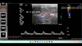 Thromboangitis ObliteransHow to ThinkDoppler Ultrasound Case [upl. by Innos124]