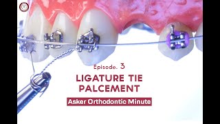 LIGATURE TIE Asker Orthodontic Minute Episode 3 [upl. by Eah]