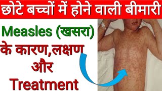 खसरा का इलाज How to care Measles in children  Measles disease in hindi Pharmacistrajneshpal [upl. by Umeko]