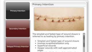 Types of Wound Closure [upl. by Nylad]