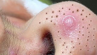 Big Cystic Acne Blackheads Extraction Blackheads amp Milia Whiteheads Removal Pimple Popping  492 [upl. by Jagir854]