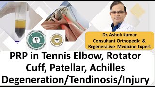 Dr Ashok Kumar PRP in Tendon Achilles Tendonitis Rotator Cuff Patellar Tendinitis Tennis Elbow [upl. by Enyleuqcaj131]