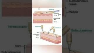 Sites of injection administration 💉knowledge medicalstudent information shortsvideo share [upl. by Akirehc981]