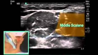 How To UltrasoundGuided Interscalene Block Scanning Technique Video [upl. by Randell]