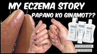 PAANO GAMOTIN ANG ECZEMA SUGAT SUGAT NA KAMAY 1 WEEK LANG [upl. by Aldus]