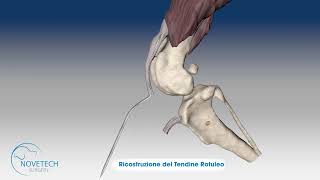 Ricostruzione del Tendine Rotuleo con NOVATEN® [upl. by Welford]